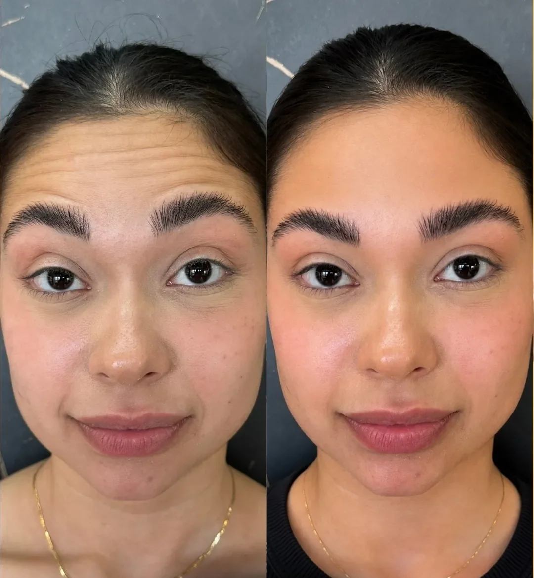 Antes e depois de toxina botulínica na testa e entre as sobrancelhas