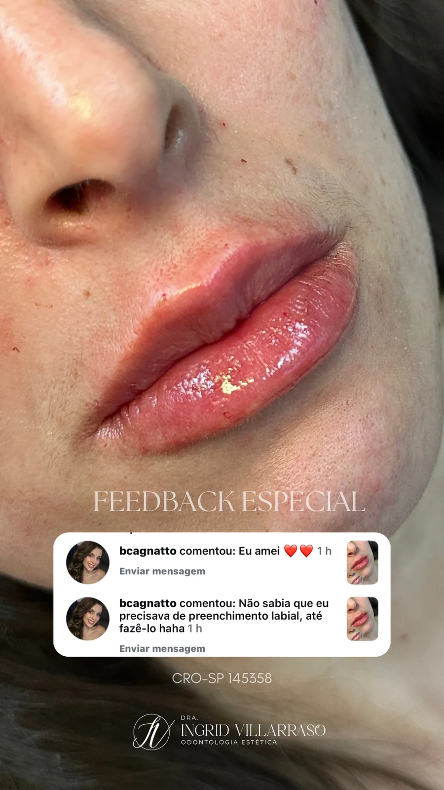 Comentário de uma paciente após o preenchimento labial
