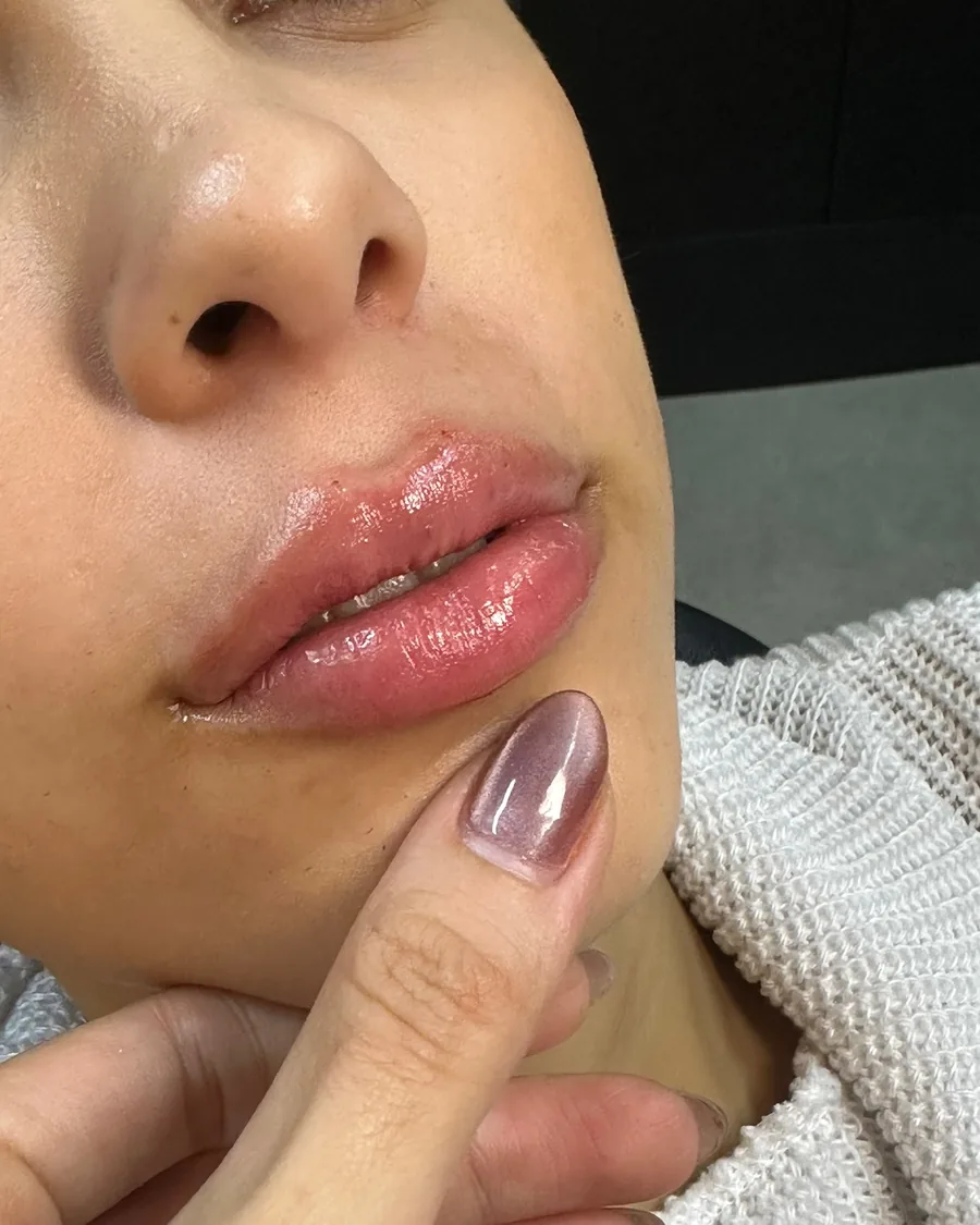 Lábios após preenchimento labial com a Dra. Ingrid